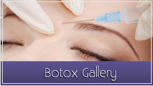 SkinCentre's Before and After Botox Gallery