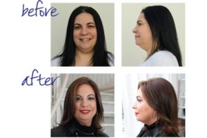 Westchester Cosmetic Surgery & Aesthetic Treatment Makeover