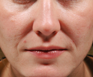 Woman's Face Before Juvederm Treatment