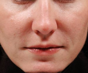 Woman's Face After Receiving Juvederm Treatment