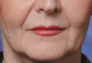 Woman's Face with Nasolabial Folds Before Restylane