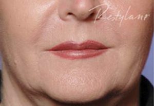 Woman's Face After Restylane Treatments
