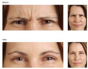 Woman Before & After Receiving Dysport Treatments