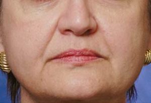 Nasolabial Folds on Woman's Face Before Restylane Treatments