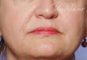 Woman's face smoothed of Nasolabial Folds after Restylane Treatments