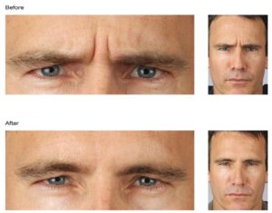 Man Before & After Receiving Dysport Treatments