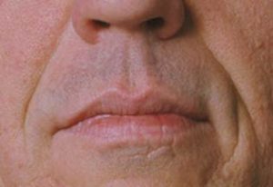 Man's Face Before Restylane Treatments