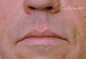 Man's Face After Restylane Treatments