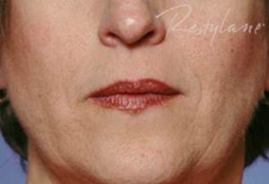 Woman with wrinkles around mouth smoothed after Restylane Treatment