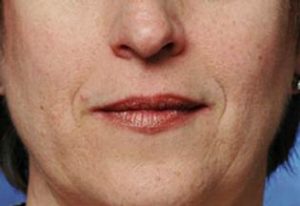 Woman with Wrinkles around Mouth Before Restylane Treatment