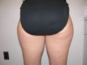 Woman's Hips & Legs Before Liposuction