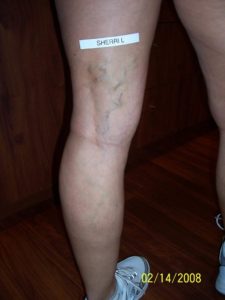 Back of Woman's Leg Before Vein Treatment