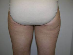 Woman's Hips & Legs After Liposuction