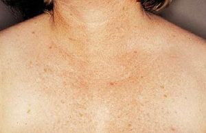 Woman's Chest After IPL Treatment