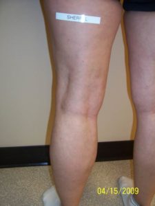 Back of Woman's Leg After Vein Treatment