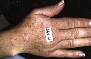 Woman's Hand Before IPL Treatment