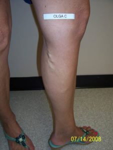 Side of Woman's Calf Before Vein Treatment
