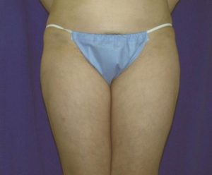 Woman's Hips After Liposuction