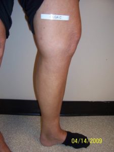 Side of Woman's Calf After Vein Treatment
