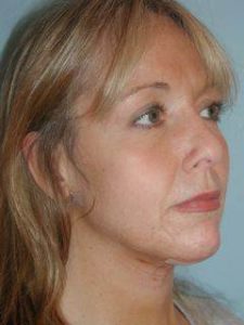 Woman's Face & Neck After Liposuction