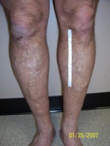Front of Man's Legs Before Vein Treatment