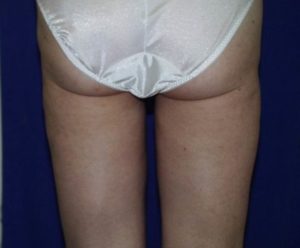 Woman's Legs After Liposuction