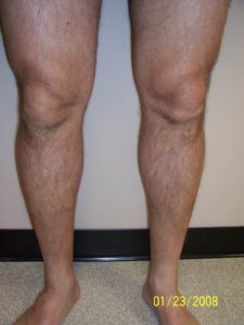 Front of Man's Legs After Vein Treatment