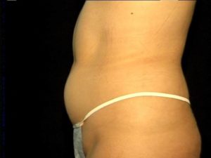 Woman's Stomach Before Liposuction