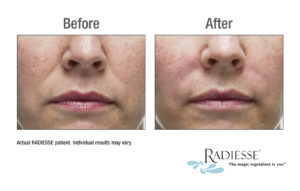 Woman's Face Before & After Radiesse Filler Treatment