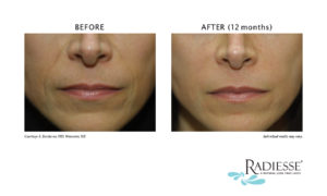 Face of a Woman Before & After Receiving Radiesse Filler Treatments