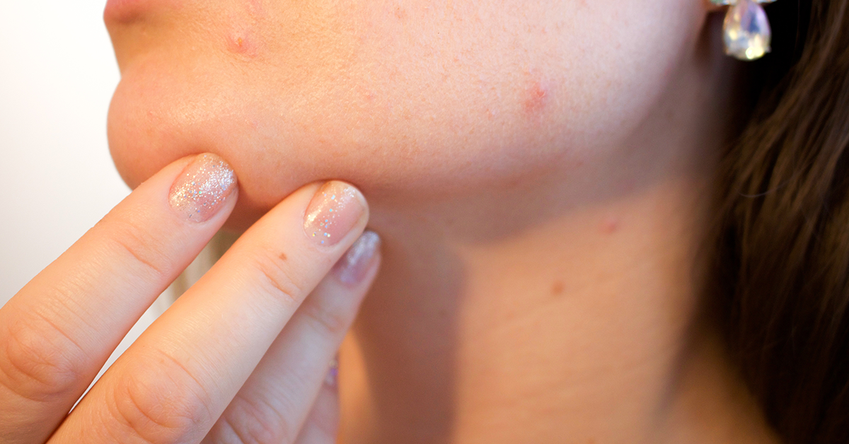 It’s Time to Talk About Adult Acne
