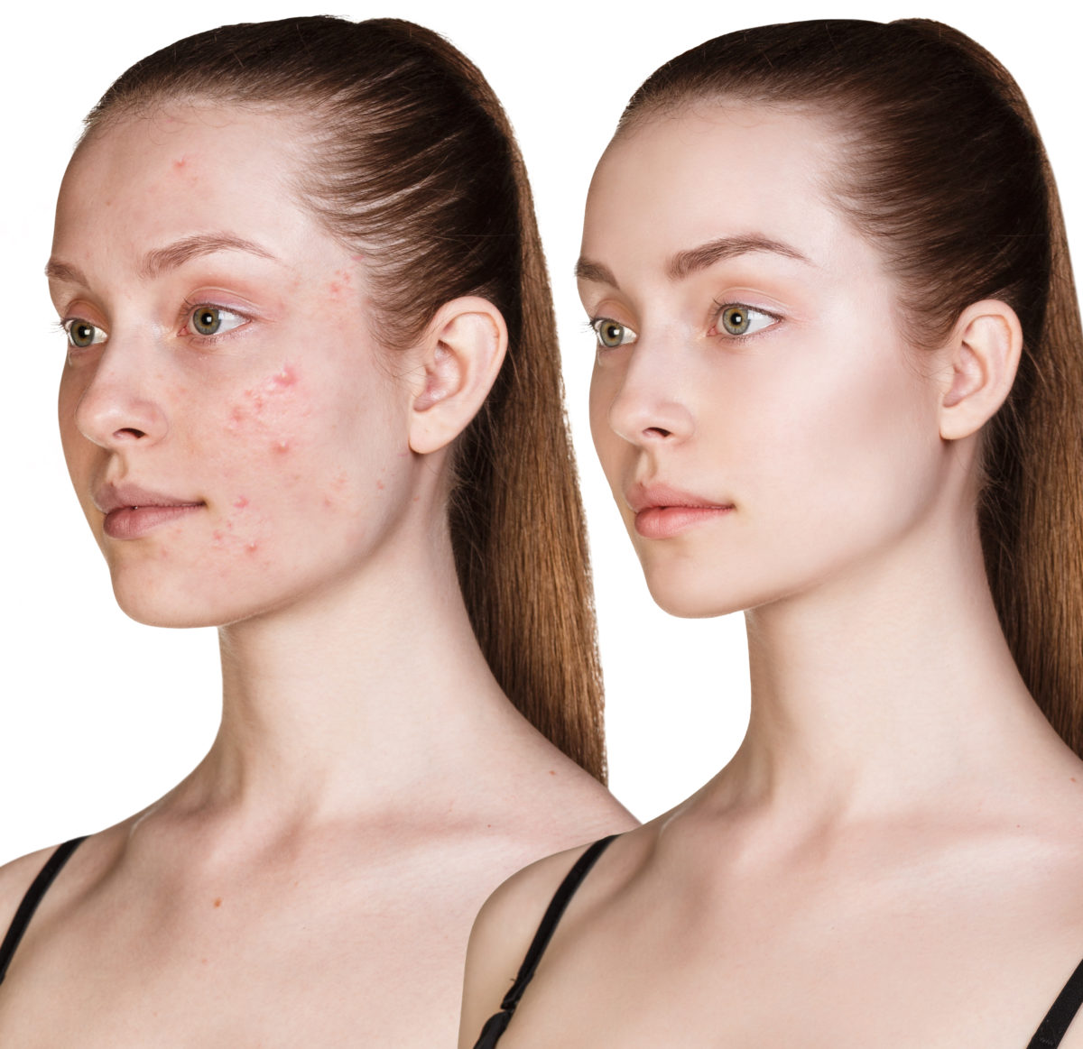 School’s Out for Summer: How to Get Ahead of Adult Acne