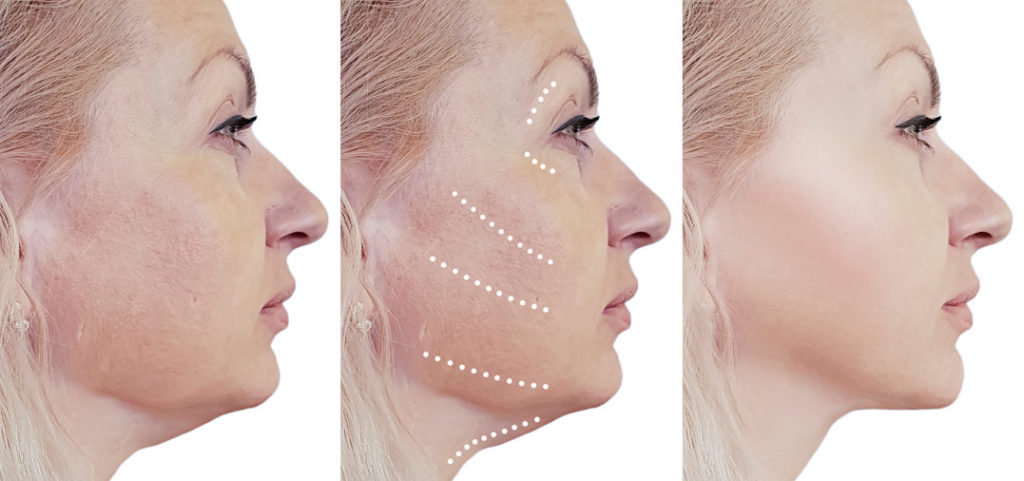 Everything You Need to Know About Thermage Skin Tightening 