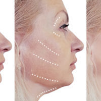 Everything You Need to Know About Thermage Skin Tightening 