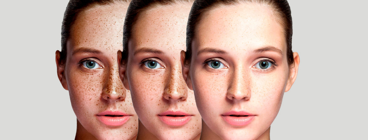 Solutions for Sun Damage, Brown Spots, and Freckles