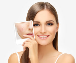 woman holding before photo that displays her skin before scar treatment