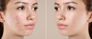 before and after picture acne treatments