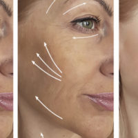 The Evolution of Beauty Treatments, Part V: Cosmetic Injectable Dermal Fillers