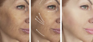 The Evolution of Beauty Treatments, Part V: Cosmetic Injectable Dermal Fillers