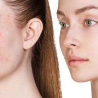 Which Acne Laser Treatment is Best for Me?