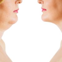 Say Goodbye to Your Double Chin with Kybella at SkinCenter