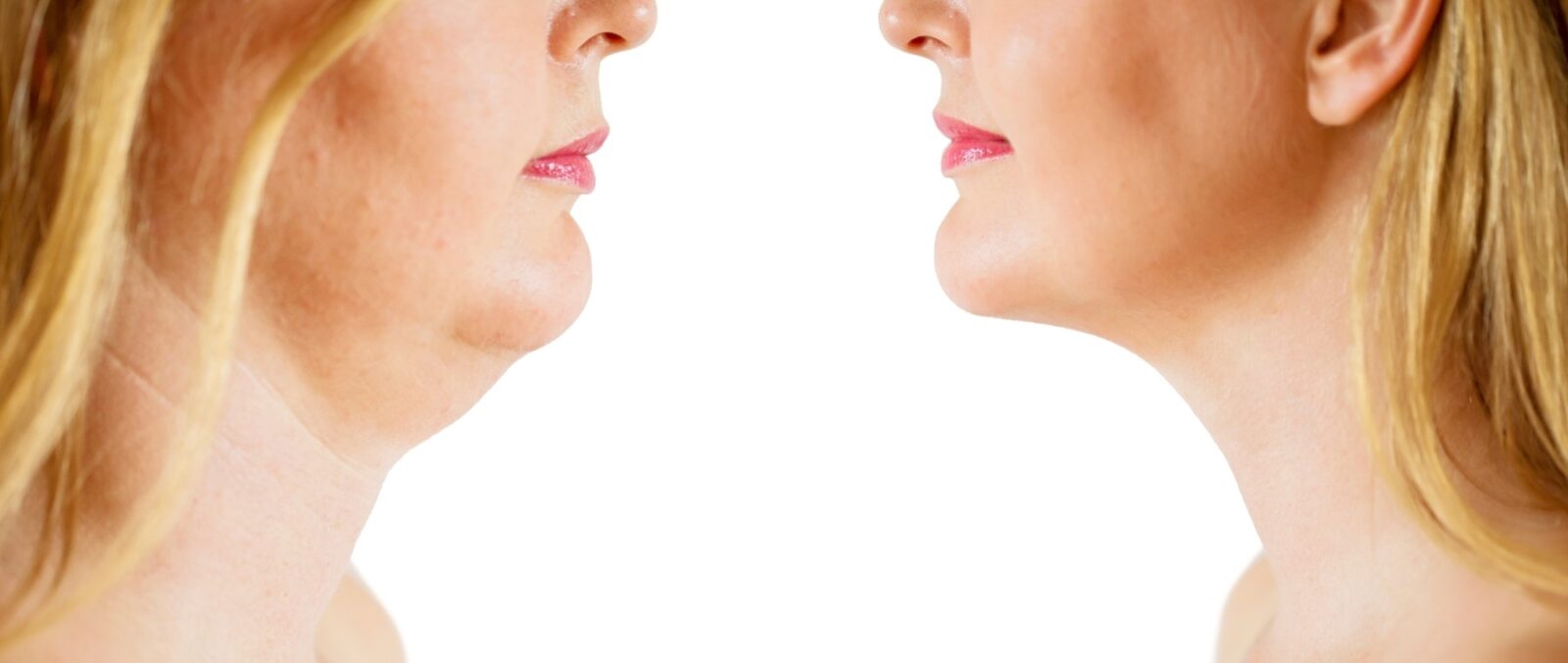 Defeat Double Chin for Good with Kybella