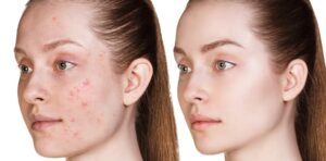 Before and after acne on woman