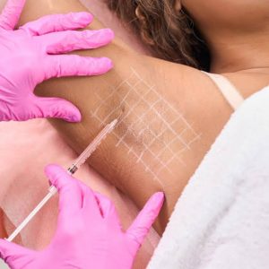 botox underarm sweat